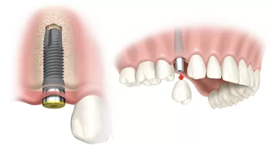 3 Giải pháp trồng răng Implant giá rẻ tại Worldwide implant