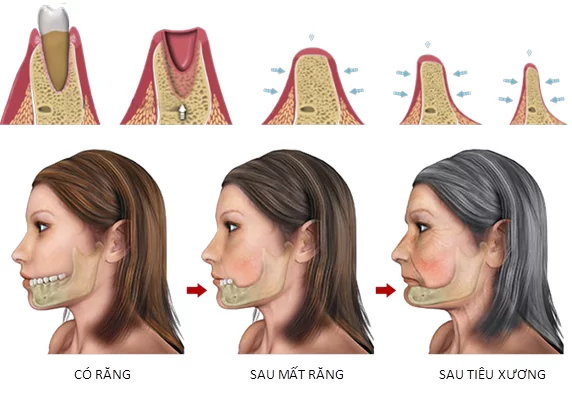 Giải pháp răng giả cho người lớn tuổi giải pháp răng giả cho người lớn tuổi