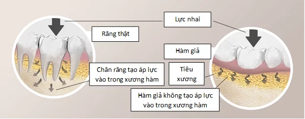 Giải pháp răng giả cho người lớn tuổi trồng răng implant