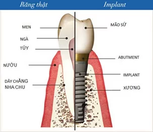 Giải pháp răng giả cho người lớn tuổi hình ảnh cấy ghép implant