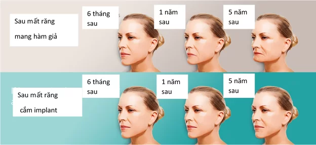 Giải pháp răng giả cho người lớn tuổi Giải pháp răng giả cho người lớn tuổi