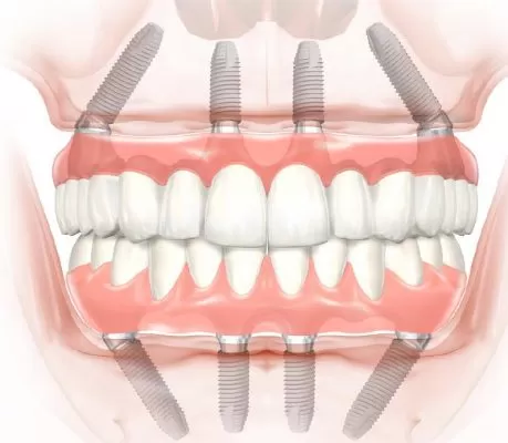 GIẢI PHÁP IMPLANT CHO NGƯỜI MẤT RĂNG TOÀN HÀM Giải pháp Implant cho người mất răng toàn hàm