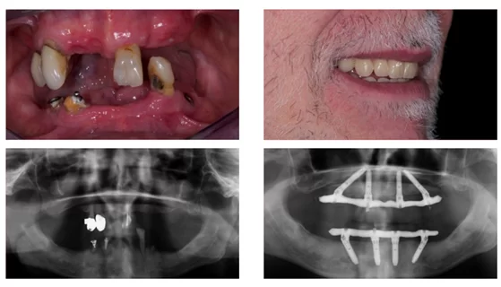 GIẢI PHÁP IMPLANT CHO NGƯỜI MẤT RĂNG TOÀN HÀM Giải pháp phục hình trên 4,6 implant