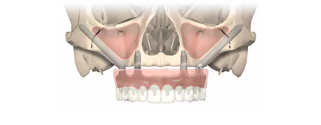 GIẢI PHÁP IMPLANT CHO NGƯỜI MẤT RĂNG TOÀN HÀM Giải pháp implant xương gò má (Zygoma implant)