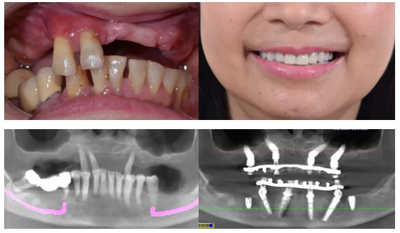GIẢI PHÁP IMPLANT CHO NGƯỜI MẤT RĂNG TOÀN HÀM Hình ảnh về ca lâm sàng phối hợp giữa All-on-4 hàm dưới và Zygoma hàm trên