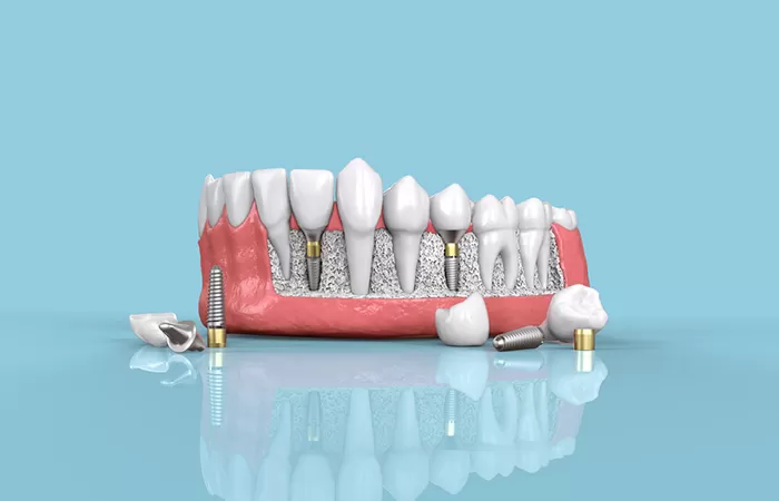 3 Giải pháp trồng răng Implant giá rẻ tại Worldwide trong rang implant gia re