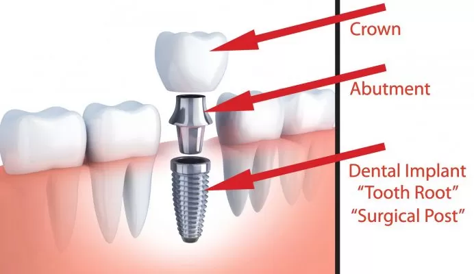 Implant nha khoa là gì? Implant nha khoa là gì?