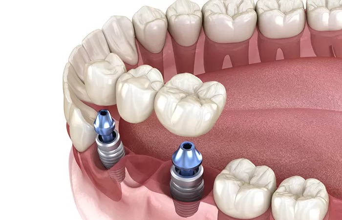 3 Giải pháp trồng răng Implant giá rẻ tại Worldwide trong rang implant gia re