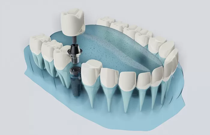 3 Giải pháp trồng răng Implant giá rẻ tại Worldwide trong rang implant gia re