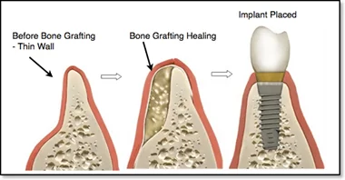 KHI NÀO THÌ CÓ THỂ ĐẶT IMPLANT SAU KHI NHỔ RĂNG??? Đặt implant trì hoãn kết hợp ghép xương
