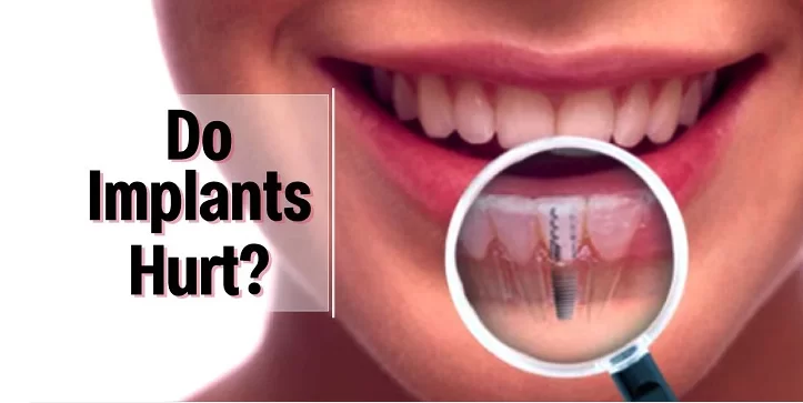 Tại Kubet Worldwide - Quy trình trồng răng implant có đau không? trong rang implant co dau khong
