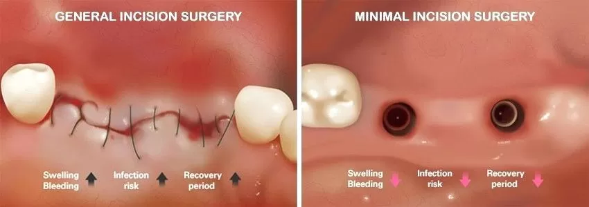 Tại Kubet Worldwide - Quy trình trồng răng implant có đau không? trong rang implant co dau khong