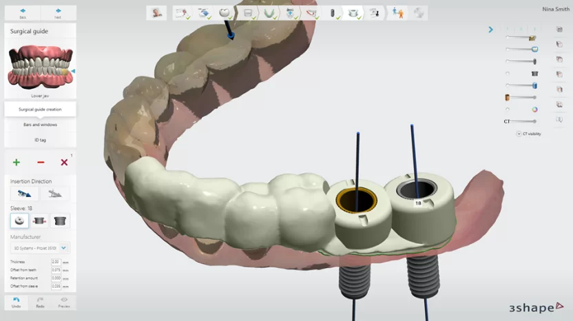 Tại Kubet Worldwide - Quy trình trồng răng implant có đau không? trong rang implant co dau khong