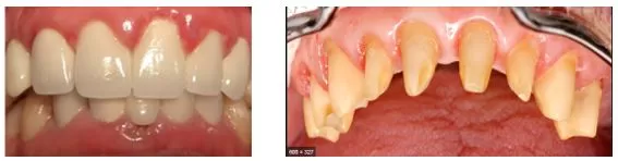 TẦM QUAN TRỌNG CỦA THIẾT KẾ NỤ CƯỜI Mài răng theo kỹ thuật cũ