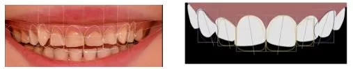 TẦM QUAN TRỌNG CỦA THIẾT KẾ NỤ CƯỜI Digital Smile Design - Thiết kế nụ cười
