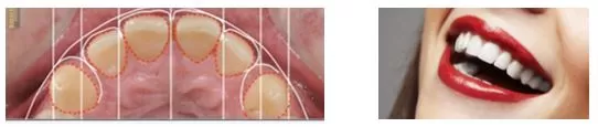 TẦM QUAN TRỌNG CỦA THIẾT KẾ NỤ CƯỜI Bản thiết kế nụ cười đẹp