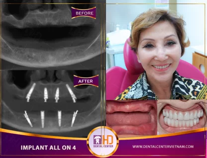 Trồng răng implant giá rẻ mà vẫn cam kết chất lượng - Chỉ có tại Worldwide Trồng răng implant giá rẻ