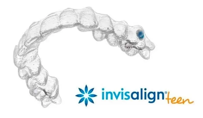 Thiếu niên có thể niềng răng trong suốt Invisalign? Chỉ số tuân thủ màu xanh trên khay niềng răng trong suốt Invisalign teen