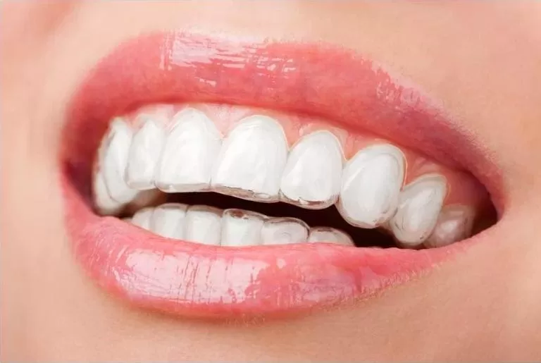 Niềng răng Invisalign áp dụng với các trường hợp nào? Rất khó để nhận ra một người đang niềng răng Invisalign nhờ khay niềng trong suốt tàng hình