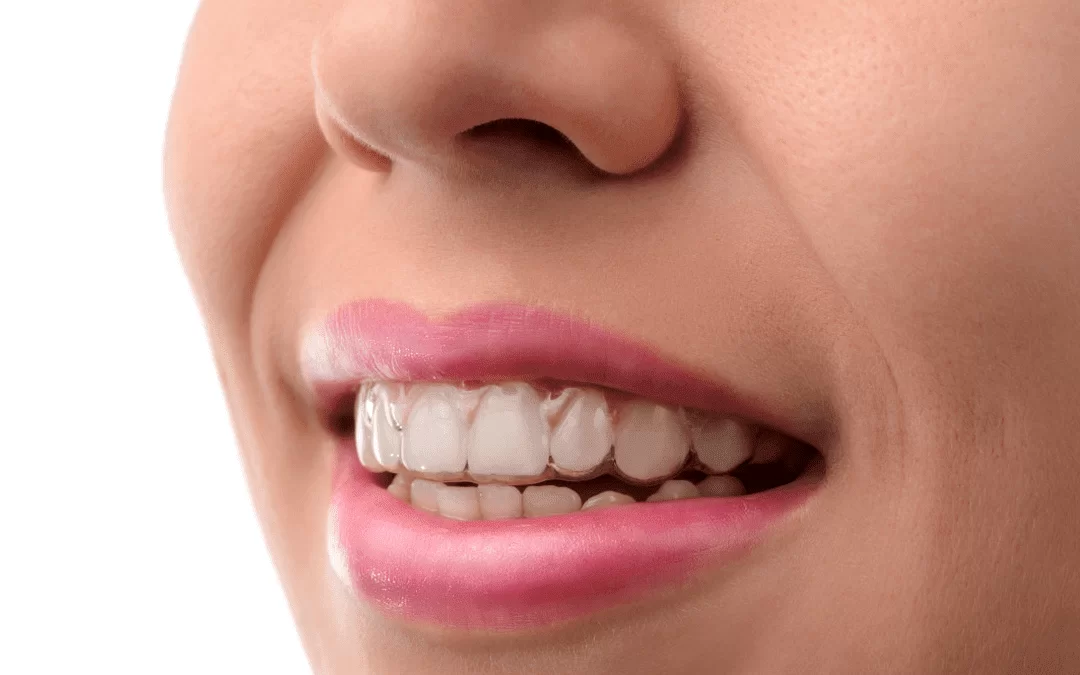 Niềng răng Invisalign có tốt không? Bạn có tin cô gái ấy đang đeo khay niềng răng trong suốt invisalign?