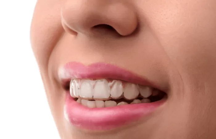 Invisalign là gì? Niềng răng trong suốt và những điều cần biết Niềng răng Invisalign có tốt không?