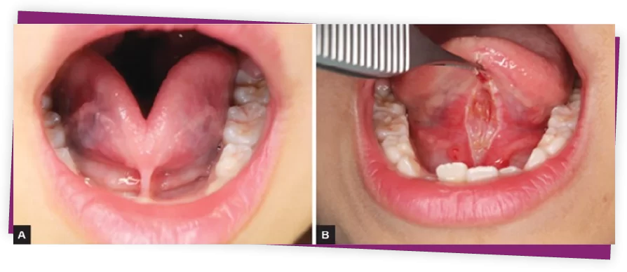 ĐIỀU CHỈNH THẮNG MÔI , THẮNG LƯỠI thắng môi