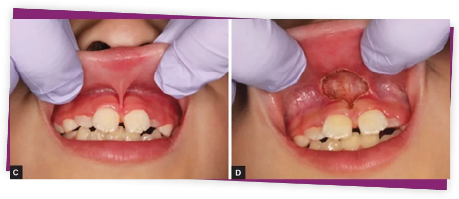 ĐIỀU CHỈNH THẮNG MÔI , THẮNG LƯỠI thắng môi