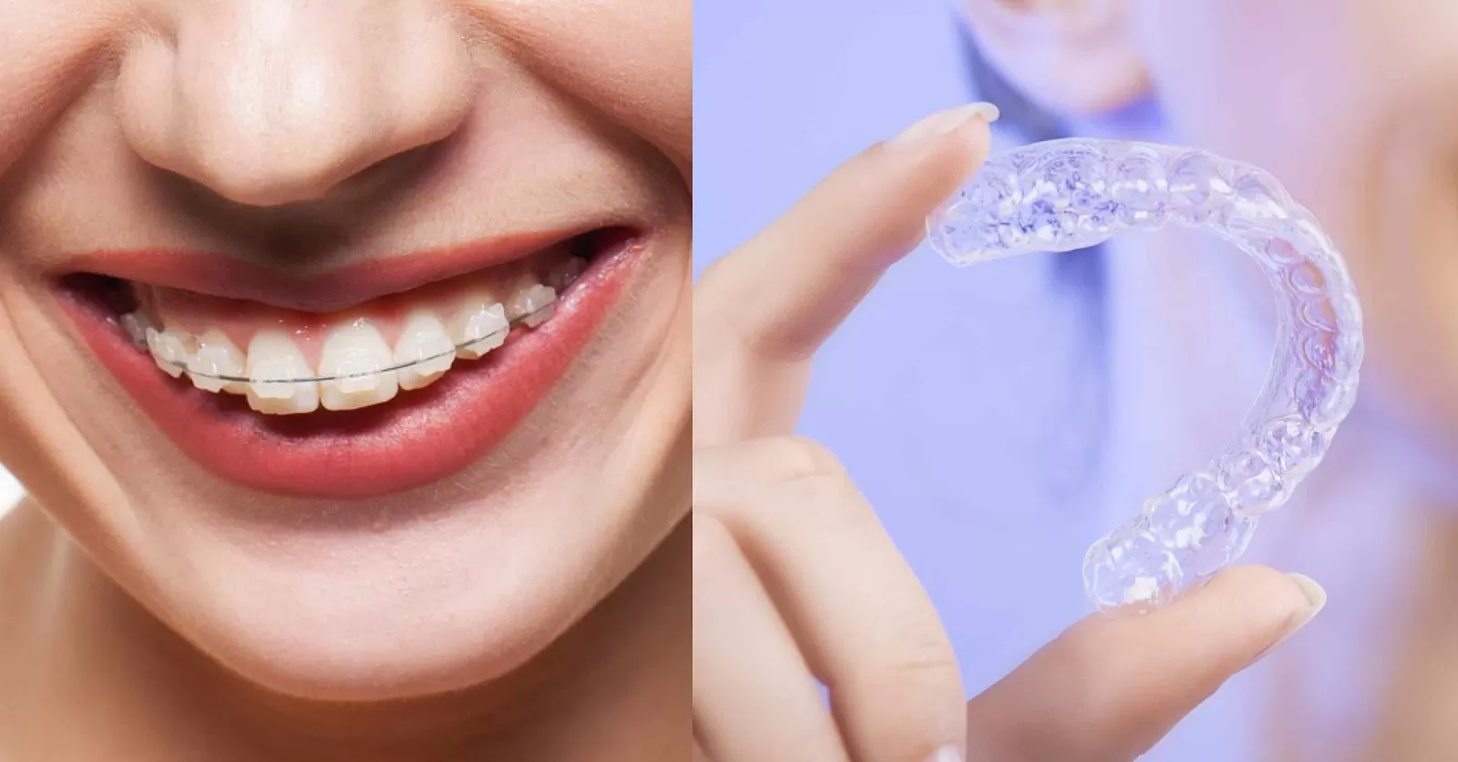 3 câu hỏi thường gặp về niềng răng không mắc cài Invisalign Niềng răng không mắc cài Invisalign có nhiều ưu điểm so với phương pháp truyền thống