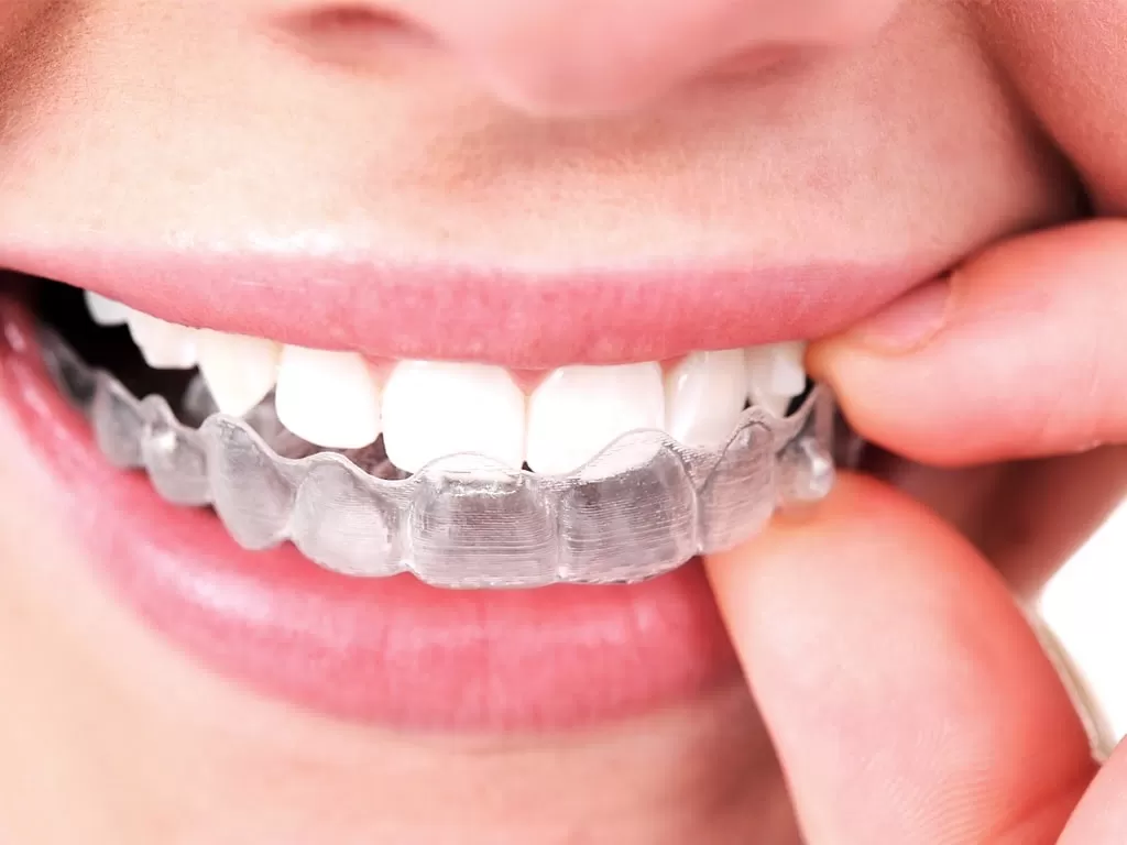 4 điểm đặc biệt cần lưu ý khi niềng Invisalign Bắt buộc phải đeo khay niềng Invisalign liên tục 22 tiếng mỗi ngày