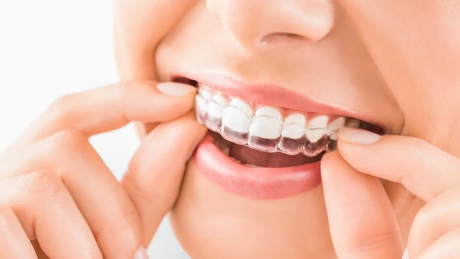 Vì sao giá niềng răng Invisalign đắt hơn niềng truyền thống? Giá niềng răng Invisalign liệu có tương xứng với hiệu quả?