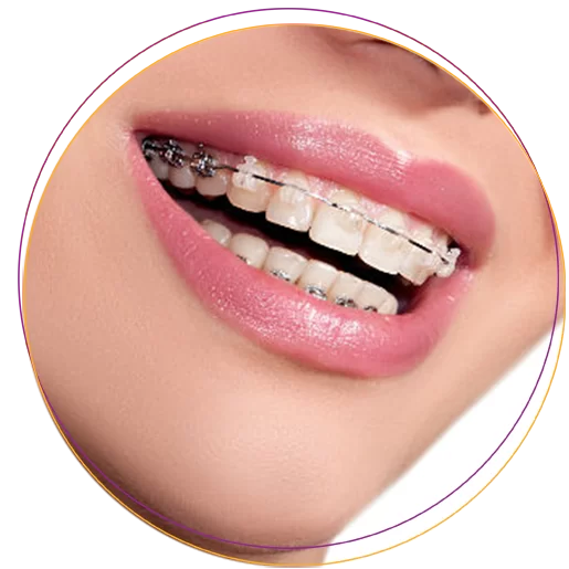 NIỀNG RĂNG MẮC CÀI Niềng răng mắc cài