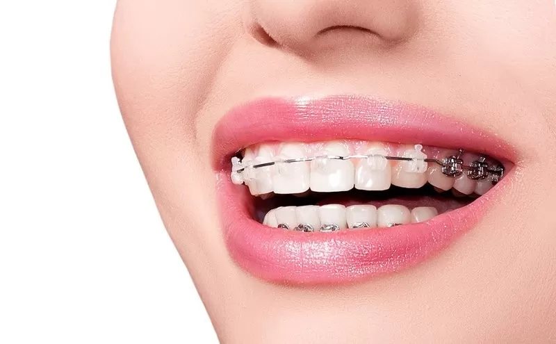 Chỉnh nha Invisalign khác gì so với niềng mắc cài? Ngoài vấn đề thẩm mỹ, niềng răng mắc cài có nhiều bất tiện và đau hơn so với chỉnh nha Invisalign.