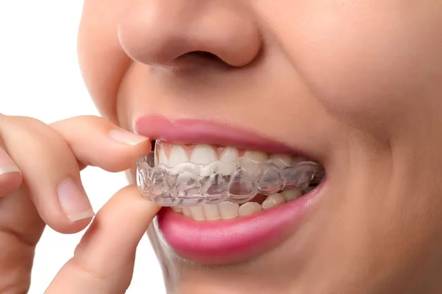 3 câu hỏi thường gặp về niềng răng không mắc cài Invisalign Khay niềng Invisalign được làm từ vật liệu SmartTrack® mềm dẻo, trong suốt, dễ dàng tháo lắp