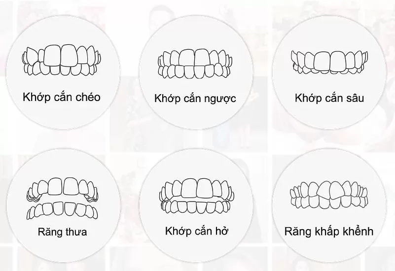Niềng răng Invisalign áp dụng với các trường hợp nào? Các trường hợp có thể áp dụng niềng răng Invisalign