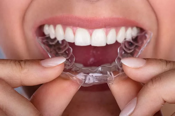 Invisalign là gì? Niềng răng trong suốt và những điều cần biết Invisalign la gi