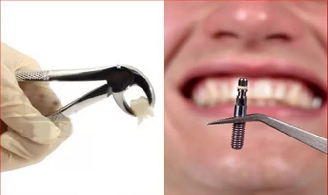 Implant - Tổng hợp tất cả các thông tin về Implant nha khoa Thay răng vừa nhổ bằng răng Implant tức thì
