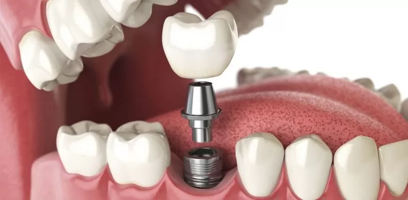 Implant - Tổng hợp tất cả các thông tin về Implant nha khoa Implant