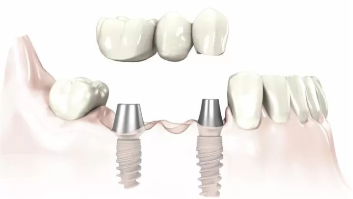 Implant - Tổng hợp tất cả các thông tin về Implant nha khoa Trồng răng Implant