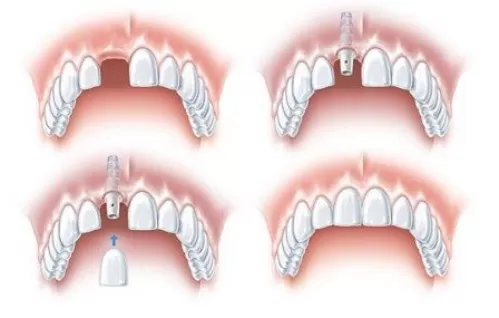 Implant - Tổng hợp tất cả các thông tin về Implant nha khoa Cấy răng Implant
