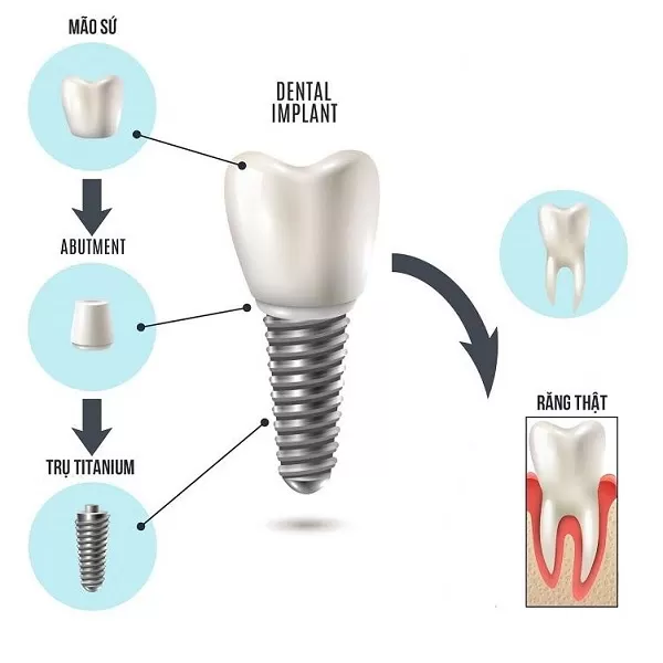 Implant - Tổng hợp tất cả các thông tin về Implant nha khoa implant