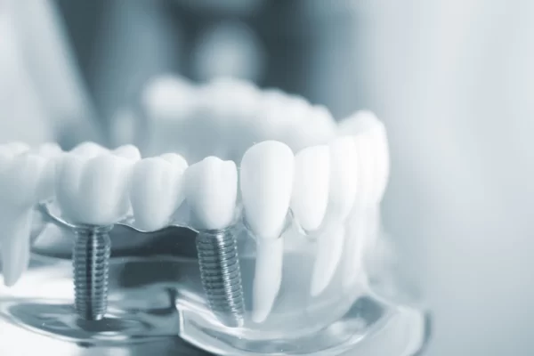 Implant - Tổng hợp tất cả các thông tin về Implant nha khoa Implant