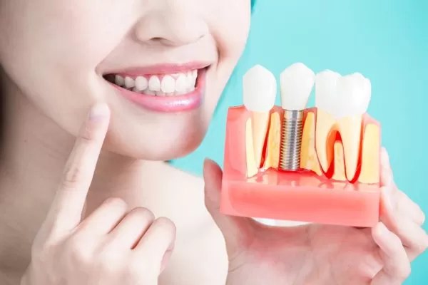 Implant - Tổng hợp tất cả các thông tin về Implant nha khoa Implant