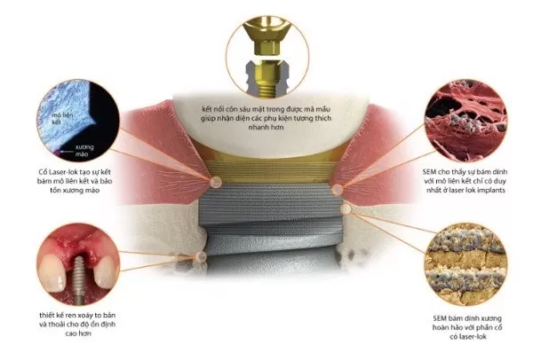 Trồng răng với công nghệ Implant: nha khoa nào tốt nhất? Công nghệ implant - IMPLANT BIOHORIZONS