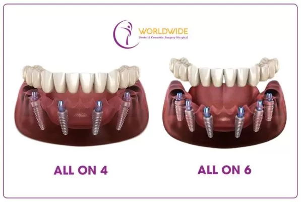 Người mất răng toàn hàm, phải làm sao? Cấy ghép Implant All-on-4 và All-on-6 là giải pháp hiệu quả cho người mất răng toàn hàm.