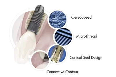 Trồng răng với công nghệ Implant: nha khoa nào tốt nhất? công nghệ implant - IMPLANT DENSPLY SIRONA
