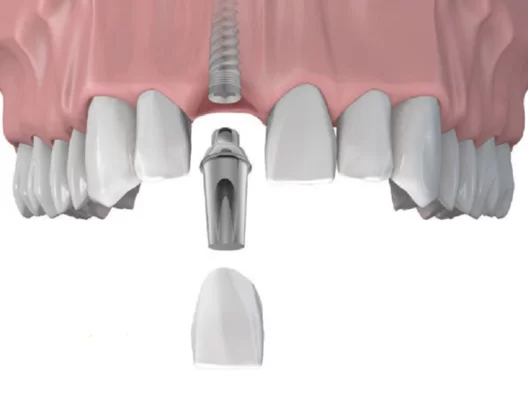 Implant - Tổng hợp tất cả các thông tin về Implant nha khoa Cấy ghép Implant cho răng cửa
