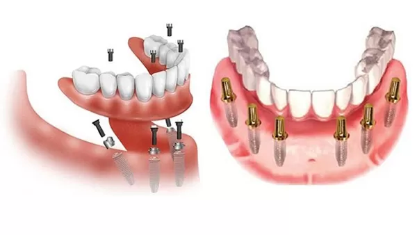 Implant - Tổng hợp tất cả các thông tin về Implant nha khoa Cấy Implant toàn hàm với kỹ thuật All-on-4; All-on-6