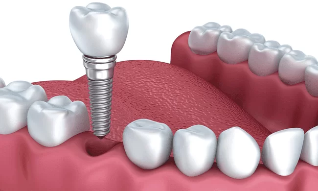 Trồng răng Implant mất bao lâu thì ăn được bình thường? Implant là giải pháp trồng răng hiệu quả nhất hiện nay