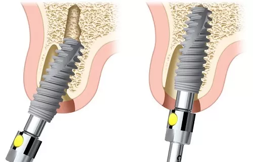 Trồng răng với công nghệ Implant: nha khoa nào tốt nhất? công nghệ Implant tức thì