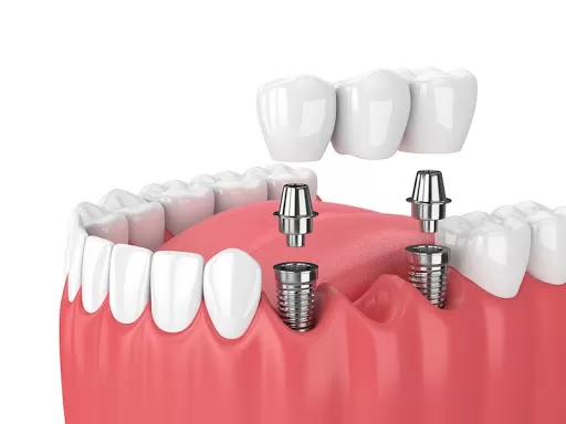 Implant - Tổng hợp tất cả các thông tin về Implant nha khoa Implant